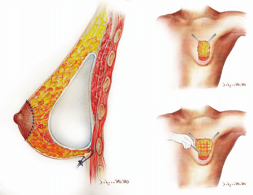 Breast Augmentation Surgery For Tubular Breasts