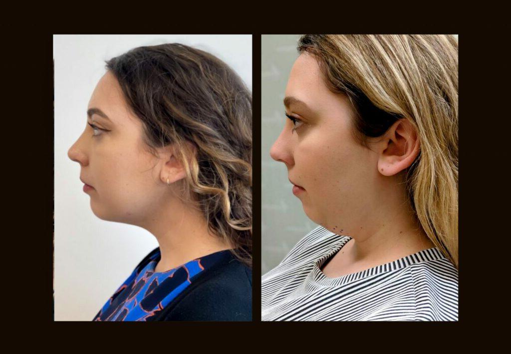 Chin Lipo Results