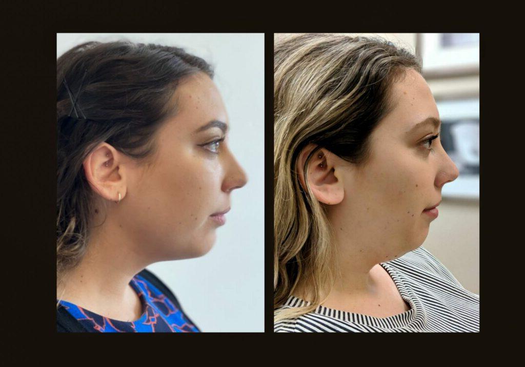 Chin Liposuction Before And After